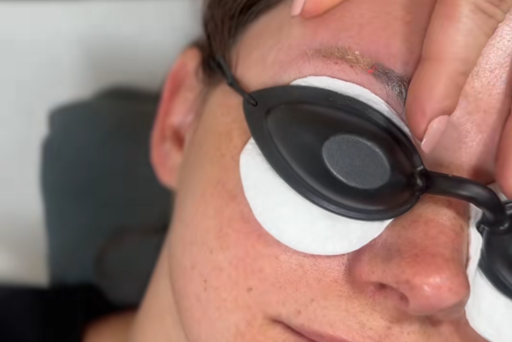 Indepartare Tatuaj cu laser